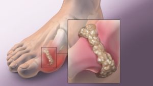 Tự kiểm tra dấu hiệu gout tại nhà trước khi quá muộn