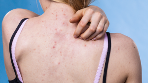 xà phòng trị mụn