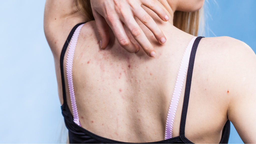 xà phòng trị mụn