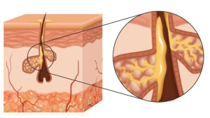 xà phòng trị mụn